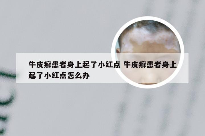 牛皮癣患者身上起了小红点 牛皮癣患者身上起了小红点怎么办