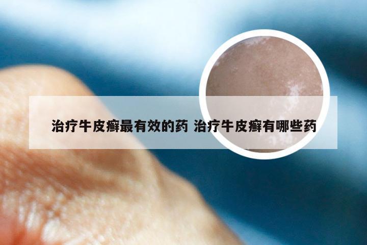 治疗牛皮癣最有效的药 治疗牛皮癣有哪些药