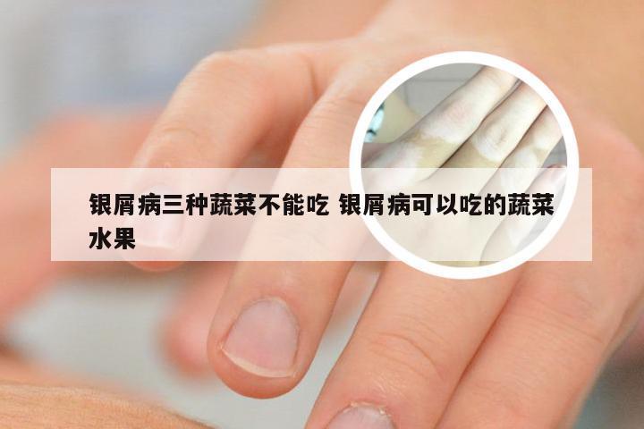 银屑病三种蔬菜不能吃 银屑病可以吃的蔬菜水果