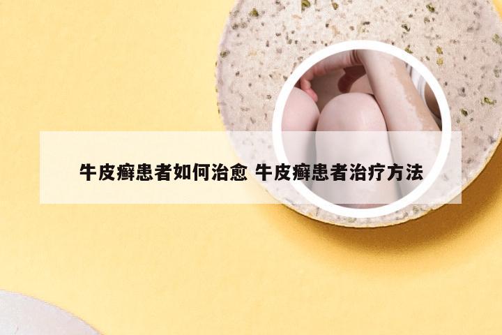 牛皮癣患者如何治愈 牛皮癣患者治疗方法