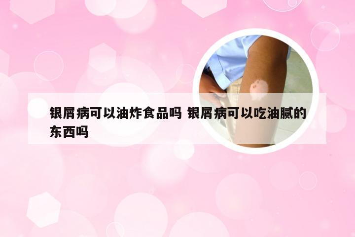 银屑病可以油炸食品吗 银屑病可以吃油腻的东西吗