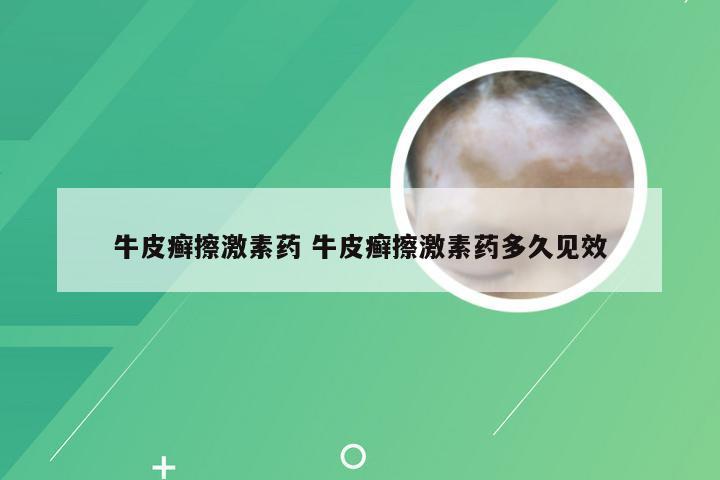 牛皮癣擦激素药 牛皮癣擦激素药多久见效