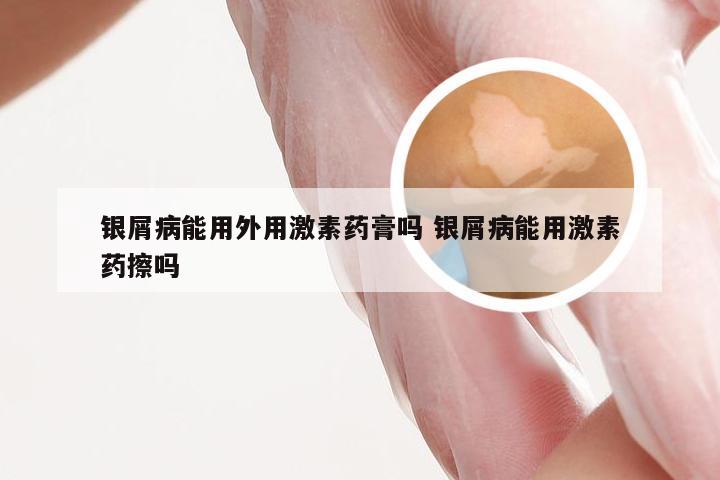银屑病能用外用激素药膏吗 银屑病能用激素药擦吗