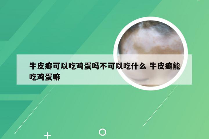 牛皮癣可以吃鸡蛋吗不可以吃什么 牛皮癣能吃鸡蛋嘛