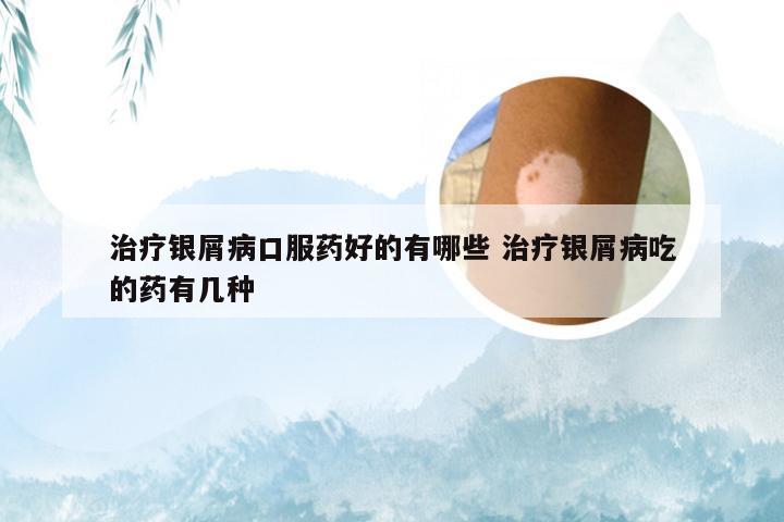 治疗银屑病口服药好的有哪些 治疗银屑病吃的药有几种