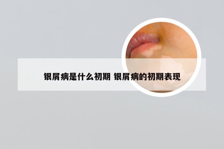 银屑病是什么初期 银屑病的初期表现