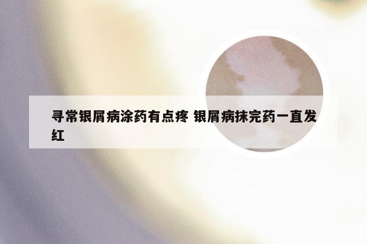 寻常银屑病涂药有点疼 银屑病抹完药一直发红