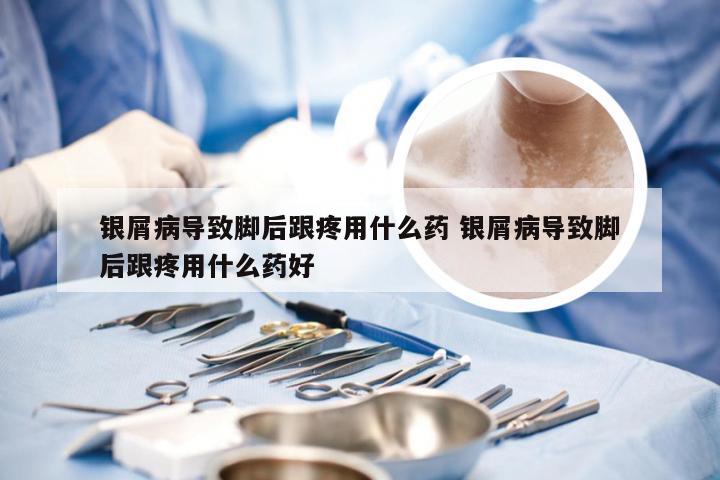 银屑病导致脚后跟疼用什么药 银屑病导致脚后跟疼用什么药好