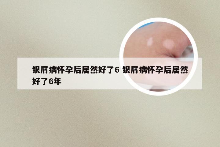 银屑病怀孕后居然好了6 银屑病怀孕后居然好了6年
