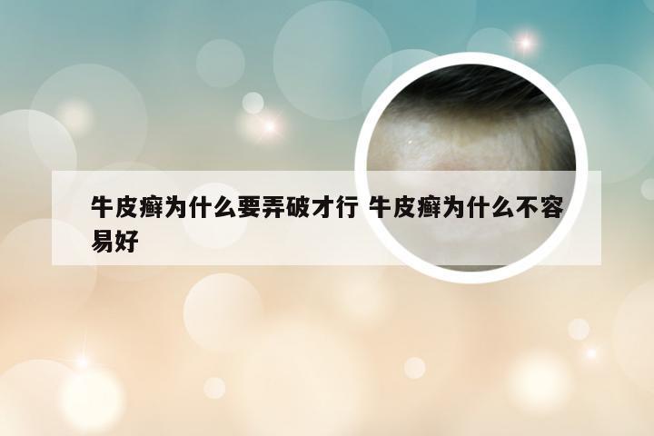 牛皮癣为什么要弄破才行 牛皮癣为什么不容易好