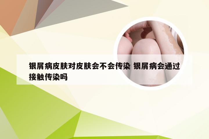 银屑病皮肤对皮肤会不会传染 银屑病会通过接触传染吗