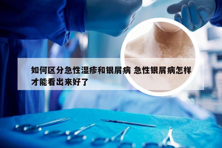 如何区分急性湿疹和银屑病 急性银屑病怎样才能看出来好了