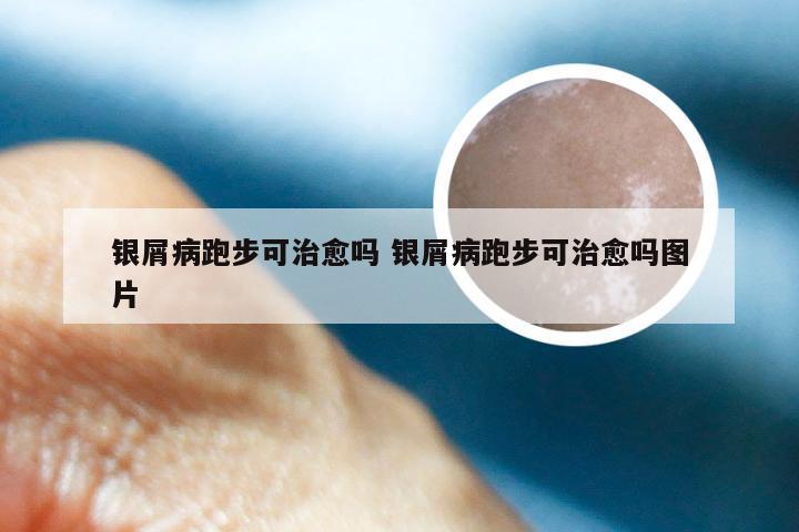银屑病跑步可治愈吗 银屑病跑步可治愈吗图片