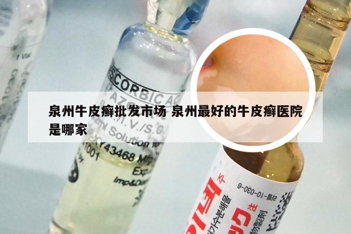 泉州牛皮癣批发市场 泉州最好的牛皮癣医院是哪家