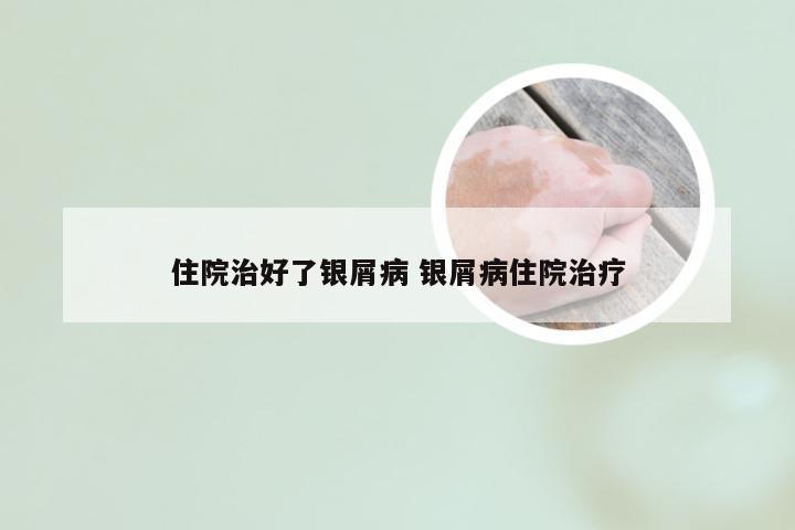 住院治好了银屑病 银屑病住院治疗