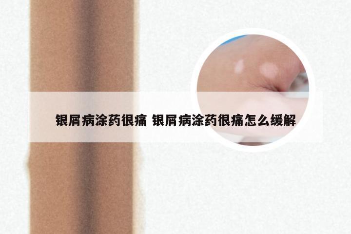 银屑病涂药很痛 银屑病涂药很痛怎么缓解