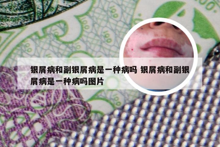 银屑病和副银屑病是一种病吗 银屑病和副银屑病是一种病吗图片