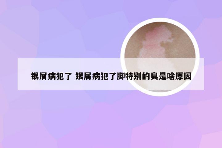 银屑病犯了 银屑病犯了脚特别的臭是啥原因