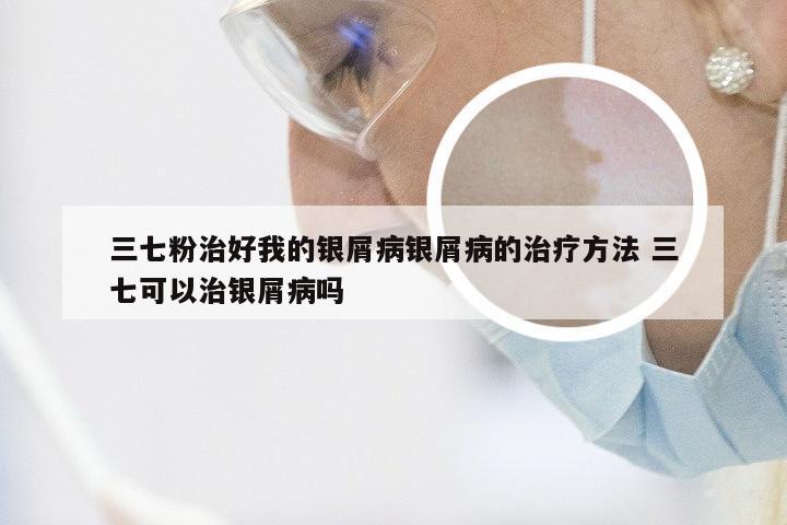 三七粉治好我的银屑病银屑病的治疗方法 三七可以治银屑病吗