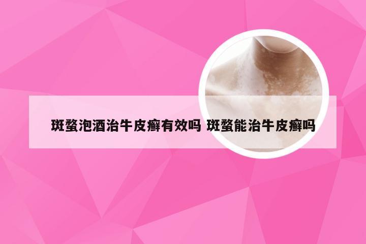 斑蝥泡酒治牛皮癣有效吗 斑蝥能治牛皮癣吗