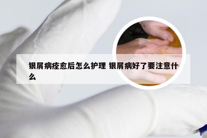 银屑病痊愈后怎么护理 银屑病好了要注意什么