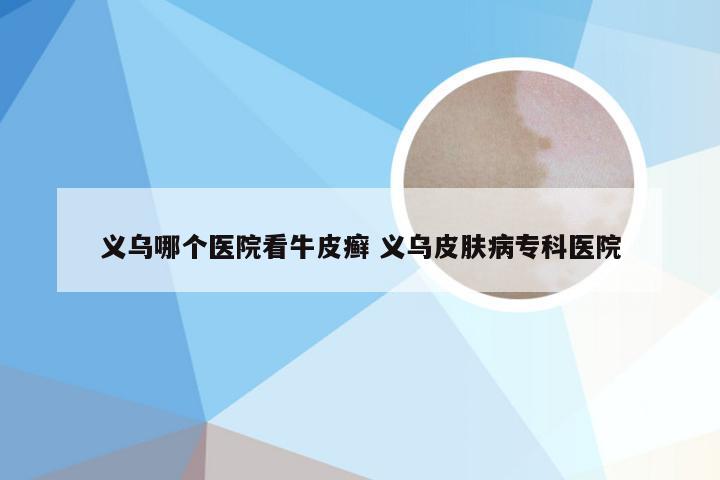 义乌哪个医院看牛皮癣 义乌皮肤病专科医院