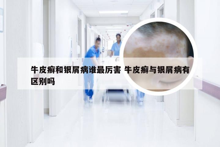 牛皮癣和银屑病谁最厉害 牛皮癣与银屑病有区别吗
