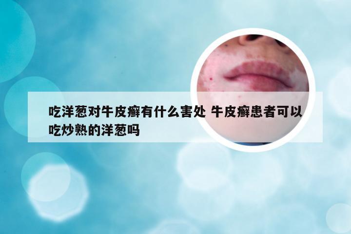 吃洋葱对牛皮癣有什么害处 牛皮癣患者可以吃炒熟的洋葱吗