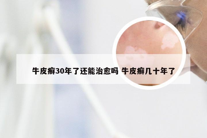 牛皮癣30年了还能治愈吗 牛皮癣几十年了