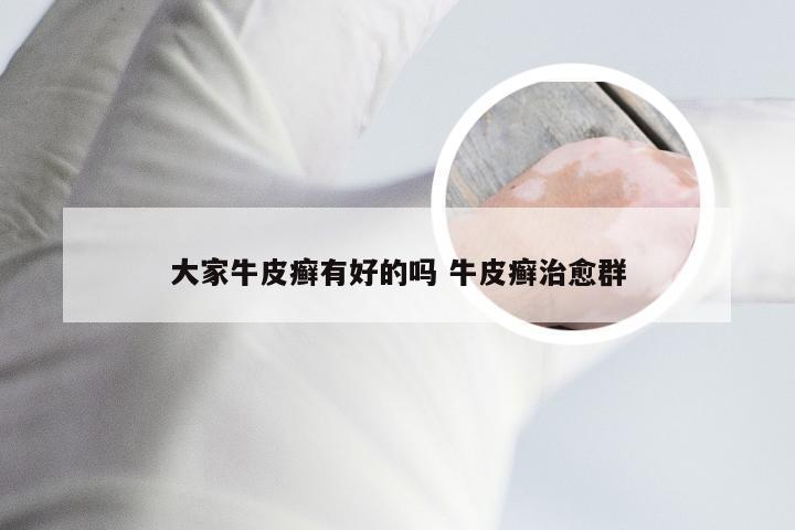 大家牛皮癣有好的吗 牛皮癣治愈群