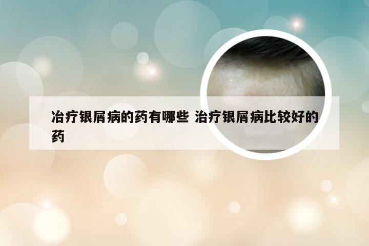 冶疗银屑病的药有哪些 治疗银屑病比较好的药