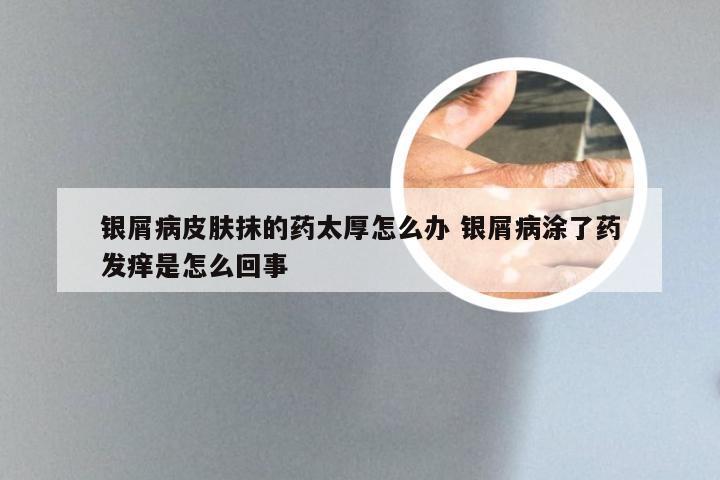 银屑病皮肤抹的药太厚怎么办 银屑病涂了药发痒是怎么回事