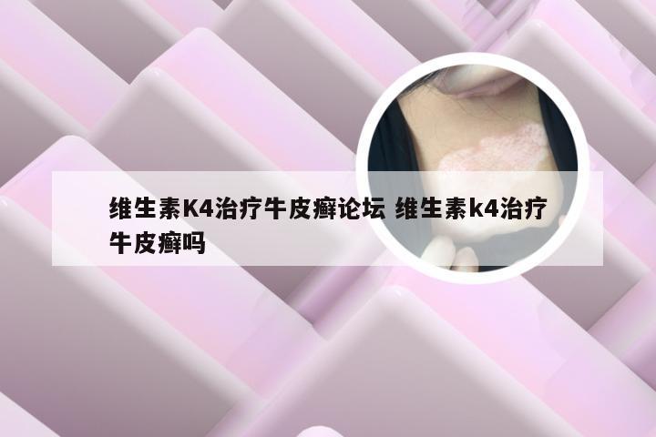 维生素K4治疗牛皮癣论坛 维生素k4治疗牛皮癣吗