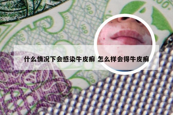 什么情况下会感染牛皮癣 怎么样会得牛皮癣