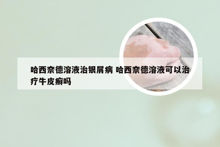 哈西奈德溶液治银屑病 哈西奈德溶液可以治疗牛皮癣吗