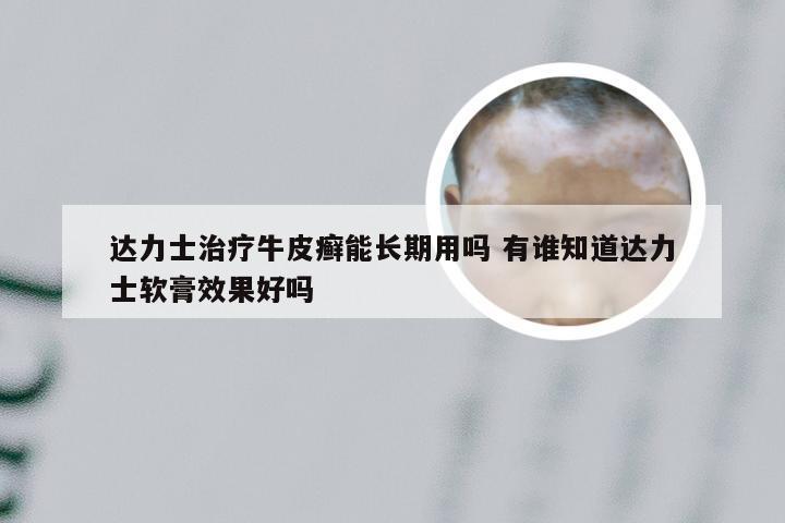 达力士治疗牛皮癣能长期用吗 有谁知道达力士软膏效果好吗