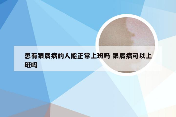 患有银屑病的人能正常上班吗 银屑病可以上班吗