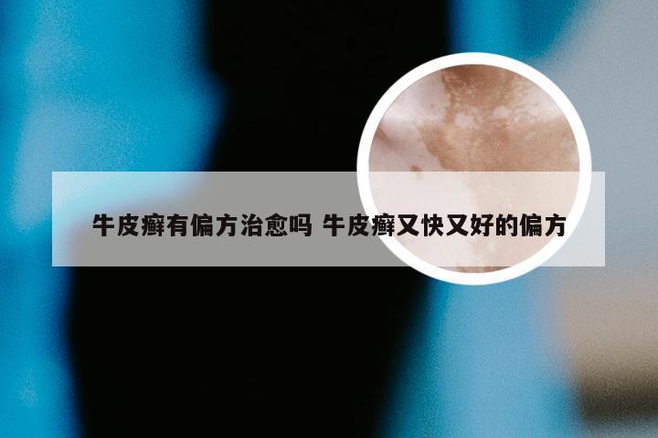 牛皮癣有偏方治愈吗 牛皮癣又快又好的偏方