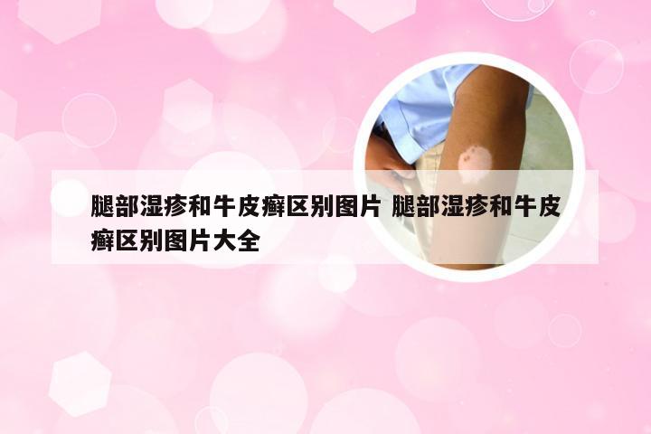 腿部湿疹和牛皮癣区别图片 腿部湿疹和牛皮癣区别图片大全