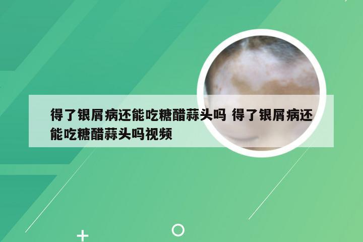 得了银屑病还能吃糖醋蒜头吗 得了银屑病还能吃糖醋蒜头吗视频