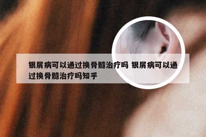 银屑病可以通过换骨髓治疗吗 银屑病可以通过换骨髓治疗吗知乎