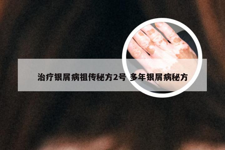 治疗银屑病祖传秘方2号 多年银屑病秘方