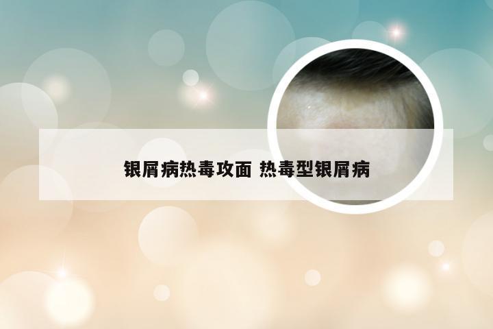 银屑病热毒攻面 热毒型银屑病