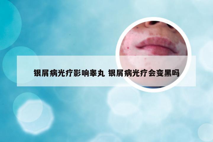 银屑病光疗影响睾丸 银屑病光疗会变黑吗