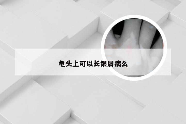 龟头上可以长银屑病么