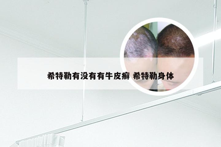 希特勒有没有有牛皮癣 希特勒身体