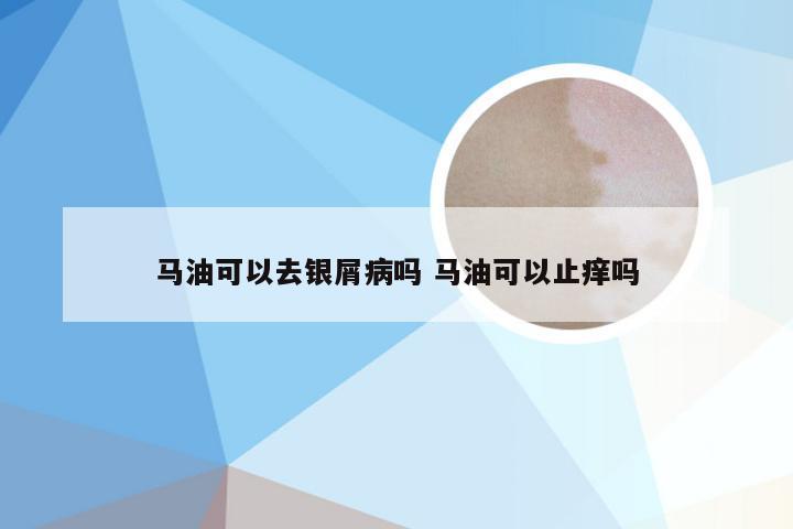 马油可以去银屑病吗 马油可以止痒吗