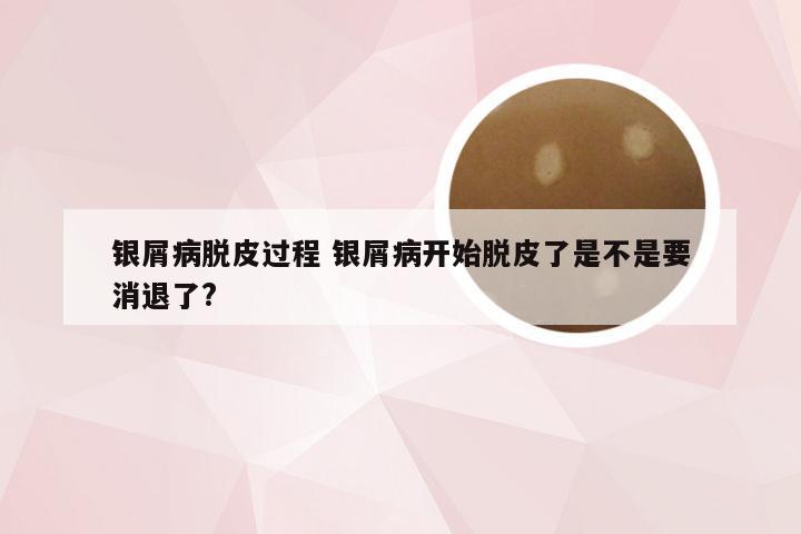 银屑病脱皮过程 银屑病开始脱皮了是不是要消退了?