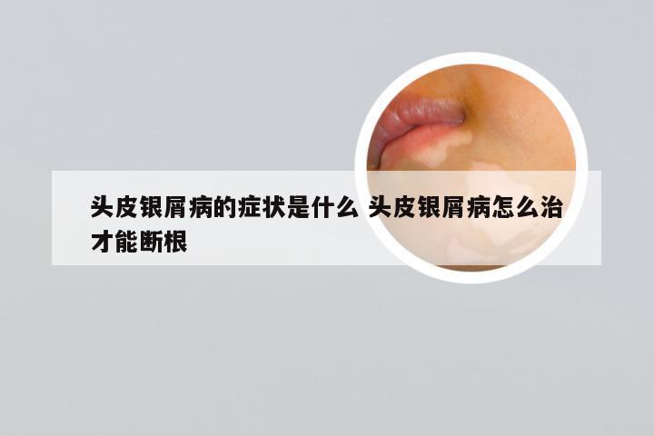 头皮银屑病的症状是什么 头皮银屑病怎么治才能断根
