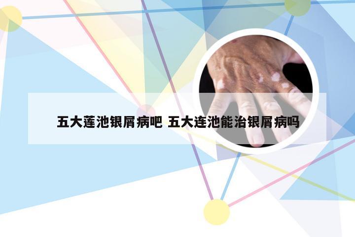 五大莲池银屑病吧 五大连池能治银屑病吗